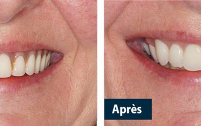 DES PROTHÈSES DENTAIRES POUR UN SOURIRE ADAPTÉ À VOTRE VISAGE